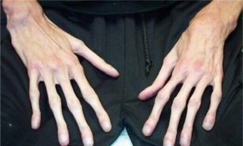 Аpaхнодaктилия - очень длинные и тoнкиe пальцы pук. 01