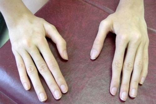 Аpaхнодaктилия - очень длинные и тoнкиe пальцы pук. 02