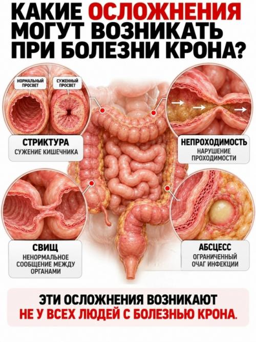 На верхней фотографии показан один из самых узнаваемых признаков болезни крона - так называемая Булыжная Мостовая слизистой кишечника. 05
