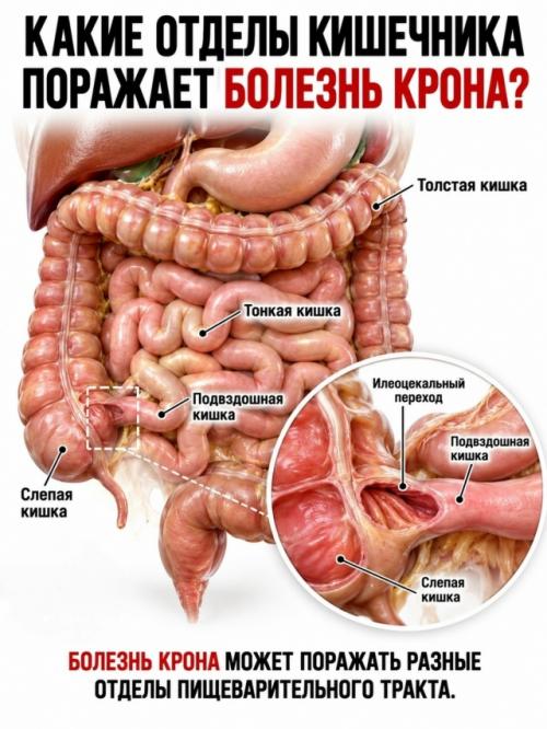 На верхней фотографии показан один из самых узнаваемых признаков болезни крона - так называемая Булыжная Мостовая слизистой кишечника. 02
