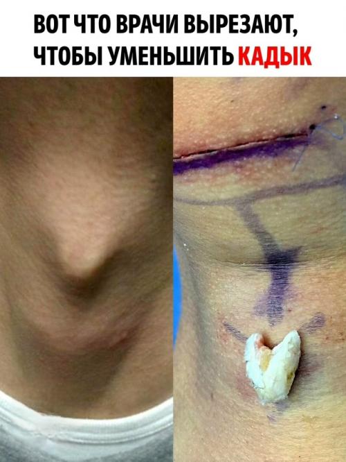 На фотографии справа показан фрагмент хряща, удалённый во время операции по уменьшению кадыка.  