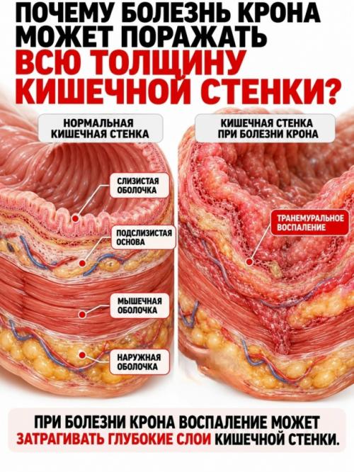 На верхней фотографии показан один из самых узнаваемых признаков болезни крона - так называемая Булыжная Мостовая слизистой кишечника. 03