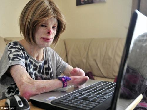 Терри калвесберт - 16-летняя американка, лицо и все тело которой представляет собой один сплошной рубец после ожога. 02