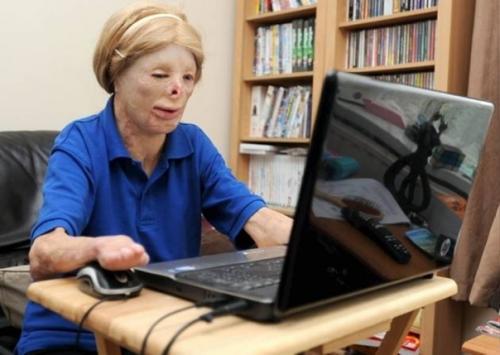 Терри калвесберт - 16-летняя американка, лицо и все тело которой представляет собой один сплошной рубец после ожога. 03