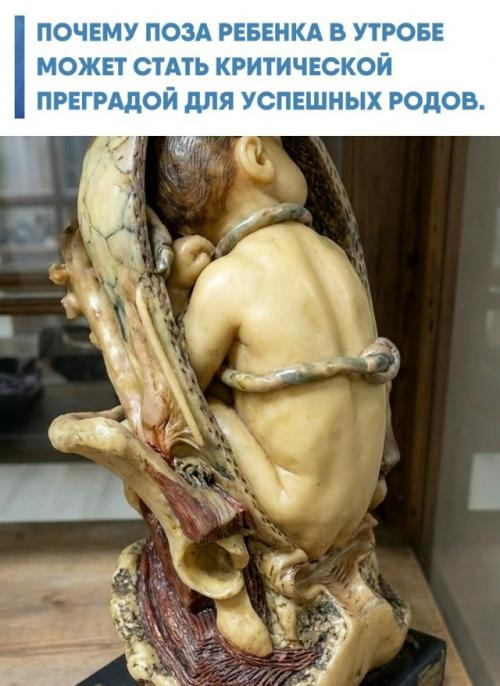 В медицинских музеях выставляют анатомические модели, где плод изображен в сидячем положении.  