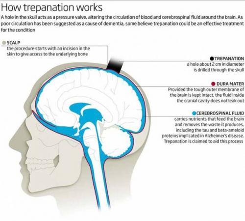 Дырки в человеческих головах: зачем их сверлили 11 тысяч лет назад? 06 Дырки в человеческих головах: зачем их сверлили 11 тысяч лет назад? 06