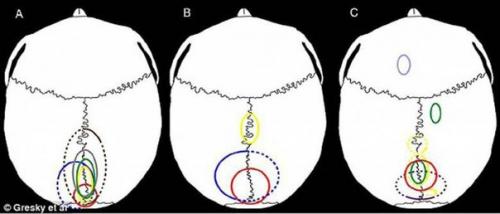 Дырки в человеческих головах: зачем их сверлили 11 тысяч лет назад? 02 Дырки в человеческих головах: зачем их сверлили 11 тысяч лет назад? 02
