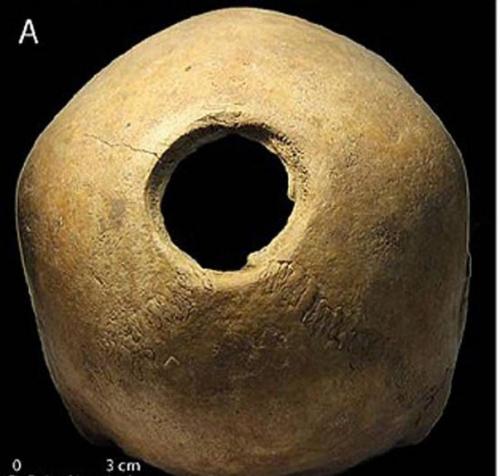 Дырки в человеческих головах: зачем их сверлили 11 тысяч лет назад? 01 Дырки в человеческих головах: зачем их сверлили 11 тысяч лет назад? 01