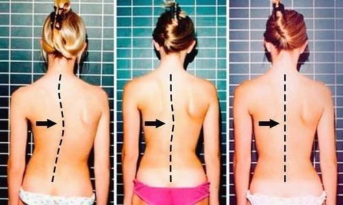 7 упражнений, которые избавят от искривления и болей в спине. 

