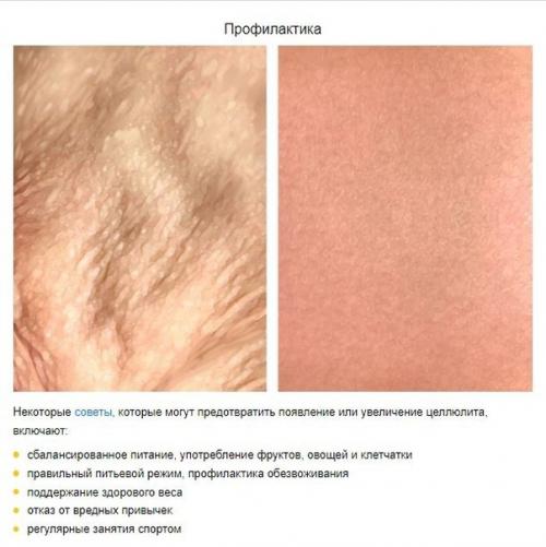 Что такое целлюлит и как он образуется. 03