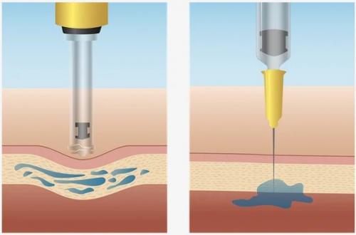 Специально для тех, кто боится уколов и иглы, существуют безыгольные инъекторы. 01