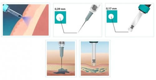 Специально для тех, кто боится уколов и иглы, существуют безыгольные инъекторы. 02