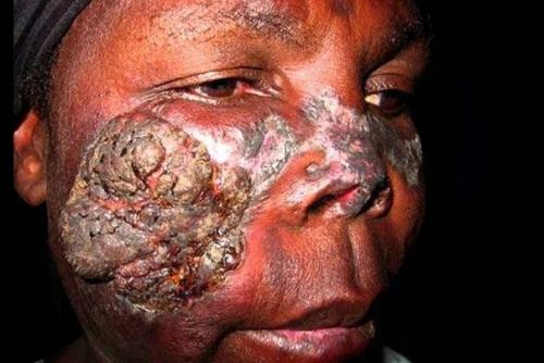 В современной медицине недуг именуют лепрой. 01