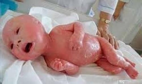 Ихтиоз арлекина. Кожа новорожденного при этом заболевании. 02