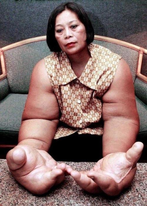 Женщина страдает редким недугом - слоновостью! 02