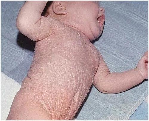 Ихтиоз арлекина. Кожа новорожденного при этом заболевании. 01