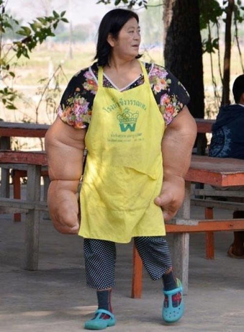 Женщина страдает редким недугом - слоновостью! 01