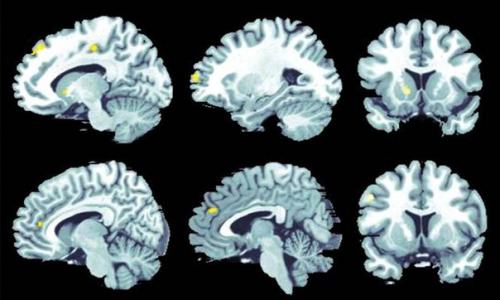 Раннюю диагностику болезни альцгеймера уточнили с помощью глубокого обучения.