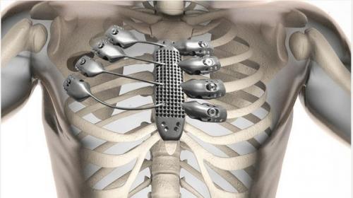 В Испании провели первую в мире операцию по пересадке рёбер, напечатанных на 3D-принтере.

