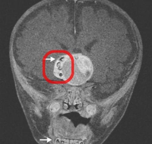 Хирургам из американского штата Мэриленд пришлось провести одну из самых тяжелых операций в их практике.  