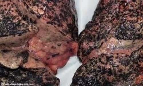 Легкие курильщика. Не забывайте: курение приносит вред вашему здоровью! 02