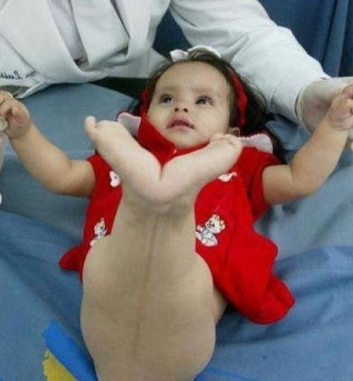 Сиреномелия или синдром русалки - аномалия развития в виде сращения нижних конечностей. 01