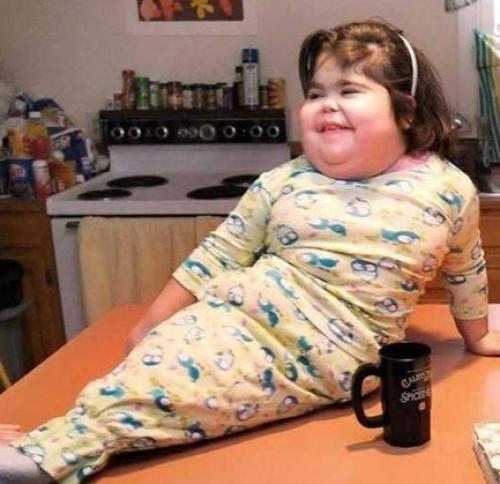 Сиреномелия или синдром русалки - аномалия развития в виде сращения нижних конечностей. 02