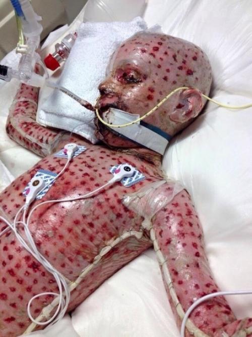 Мальчик чудом страшное кожное заболевание поборол. 01