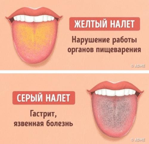 Как определить состояние здоровья по цвету языка? 05