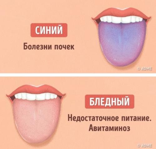 Как определить состояние здоровья по цвету языка? 02