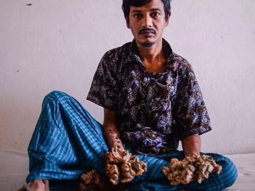 Человек - Дерево из Индии. 01