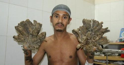 Человек - Дерево из Индии. 02